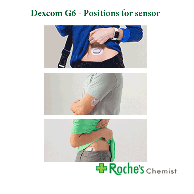 dexcom-sensor-positions.gif